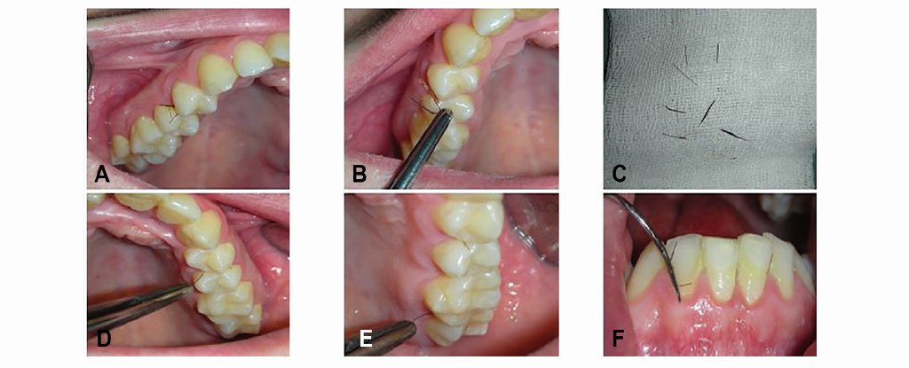 极其罕见的医学病例：一名妇女的牙龈长出了毛
